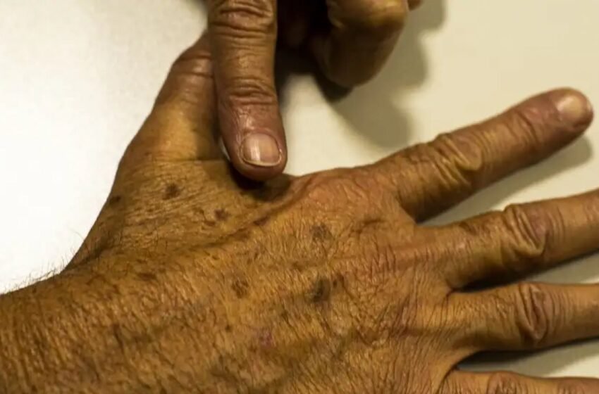  Mutirão de prevenção e diagnóstico do câncer de pele oferece atendimento gratuito